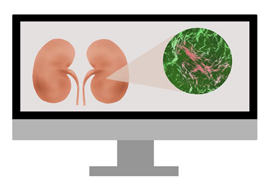 肾结石是一种急性的肾脏部位的病变，在患上肾结石之后，很多人如果结石比较小的话，是可以自己经过调理让结石排出来的。