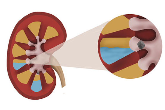 现在的人由于总是不爱喝水，不当饮食，就很容易造成肾脏上面长小石子，病情发作的时候，会让患者非常的痛苦。