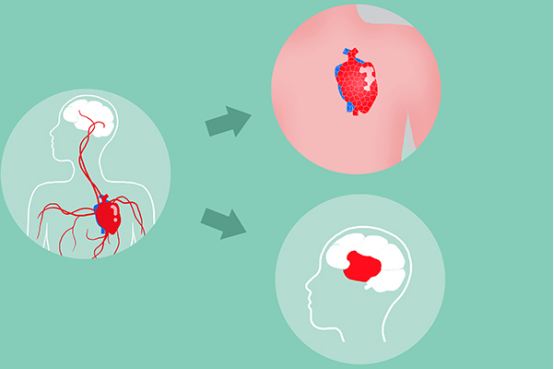 动脉硬化是现在比较常见的一种疾病，很多人认为一旦患上了这种疾病，那么就会对寿命造成一定的影响。