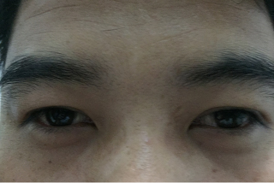 黑眼圈是眼睛下面发黑的一种眼部皮肤异常现象.