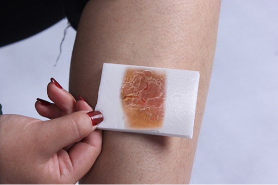 皮肤莫名的出现瘙痒的感觉,会让人十分的不舒服,一些人忍不住用手去挠,结果发现越挠越痒,经检查发现是湿疹,不及时治疗,只会让不适感加重。 皮肤莫名的出现瘙痒的感觉,会让人十分的不舒服,一些人忍不住用手去挠,结果发现越挠越痒,经检查发现是湿疹,不及时治疗,只会让不适感加重。