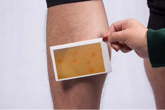 荨麻疹虽然不是非常严重的疾病,但是它的出现会给患者带来很大的伤害,对于精神方面也有一定的影响,及时的治疗,可以缓解不良的症状。 荨麻疹虽然不是非常严重的疾病,但是它的出现会给患者带来很大的伤害,对于精神方面也有一定的影响,及时的治疗,可以缓解不良的症状。