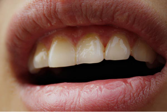 牙龈肿痛是发炎引起的话,建议大家还是及时采取抗炎的治疗,适当服用一些消炎药或者是通过喷一些消炎的药物来帮助消除牙龈的肿痛的感觉。 牙龈肿痛是发炎引起的话,建议大家还是及时采取抗炎的治疗,适当服用一些消炎药或者是通过喷一些消炎的药物来帮助消除牙龈的肿痛的感觉。