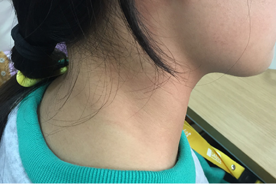 omega脖子腺体图片后颈图片