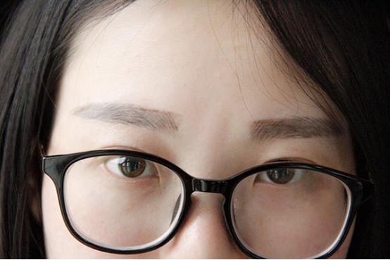 白内障是生活中比较常见的一种疾病,初期的时候对视力不会有什么影响,但不及时治疗的话,病情会逐渐加重,严重时可能会导致失明。 白内障是生活中比较常见的一种疾病,初期的时候对视力不会有什么影响,但不及时治疗的话,病情会逐渐加重,严重时可能会导致失明。