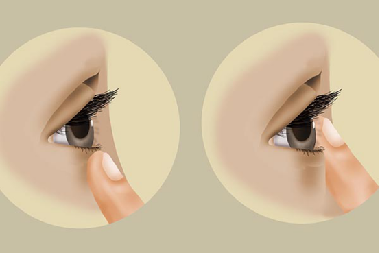 患上结膜炎之后,结膜表面的血管会处于一个扩张的状态,局部会充血,所以眼睛看起来红红的,但是不会有疼痛感。 患上结膜炎之后,结膜表面的血管会处于一个扩张的状态,局部会充血,所以眼睛看起来红红的,但是不会有疼痛感。