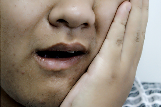 腮腺炎怎么治疗