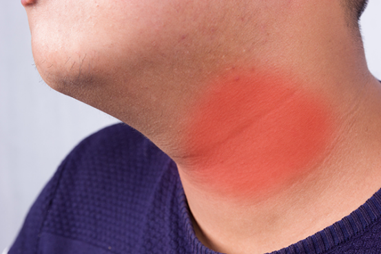 促甲状腺激素高的原因是什么