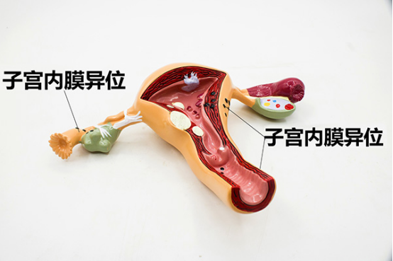 子宫内膜异位症怎么治 子宫内膜异位症怎么治