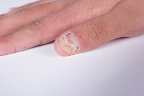指甲白斑是癌症前兆吗