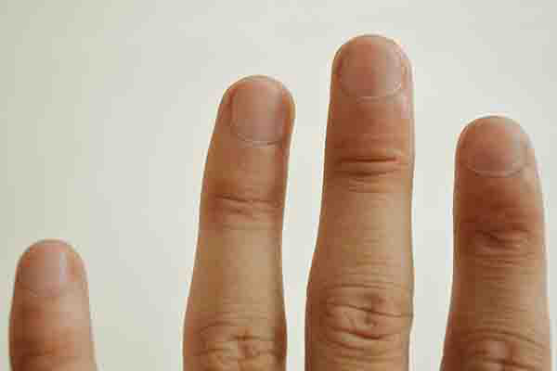 指甲竖纹多是癌症吗