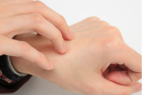 很多人都出现后皮肤过敏痒现象,一旦发作起来,患者会感觉到十分的痛苦,用力程度比较重时,皮肤还会被抓破,容易造成感染,身体健康状况就会受到一定的影响。 很多人都出现后皮肤过敏痒现象,一旦发作起来,患者会感觉到十分的痛苦,用力程度比较重时,皮肤还会被抓破,容易造成感染,身体健康状况就会受到一定的影响。