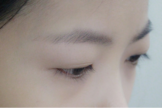 上眼皮浮肿是什么原因 上眼皮浮肿是什么原因