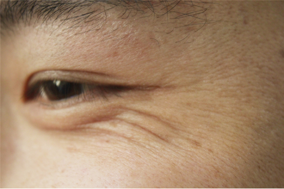 眼皮下垂了该怎么办 眼皮下垂了该怎么办