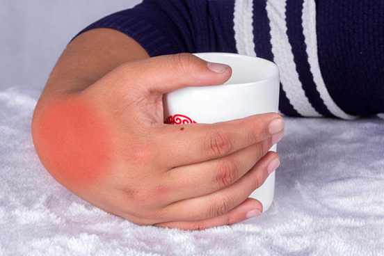 尿酸盐沉积导致的痛风石