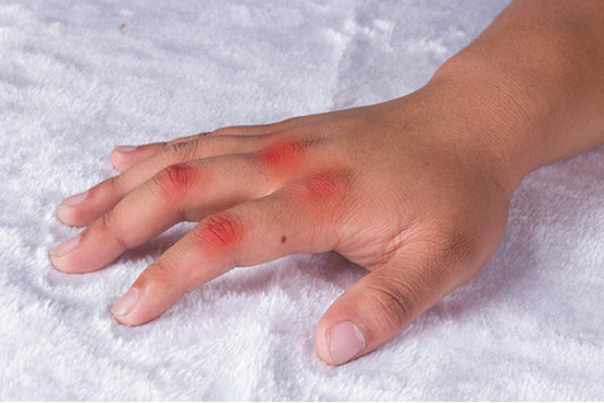 痛风发作多半是因为摄入了大量嘌呤含量高的食物引发的