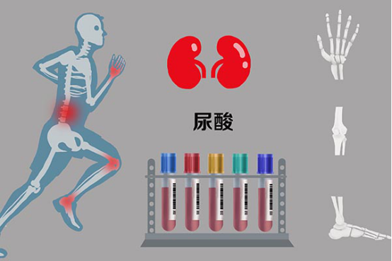肾脏损伤是比较常见的痛风并发症