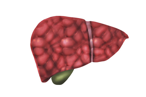 肝硬化晚期的寿命，没有一个定数