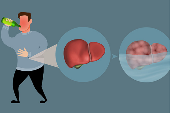 肝硬化早期能活几年与患者的病情有关