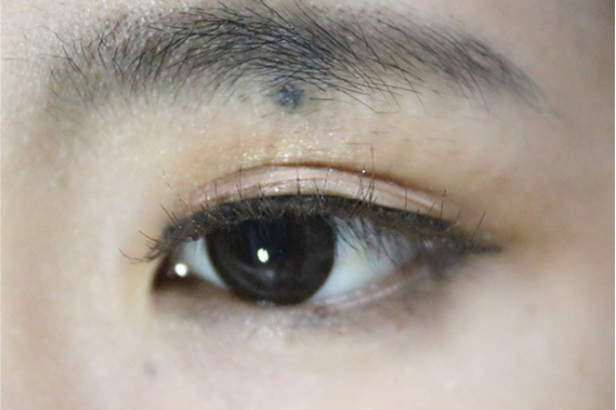 眼睛有红血丝与眼睛受到细菌感染有关