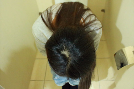  做好产后护理，痔疮便会慢慢缩回去