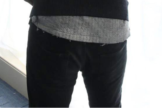 混合痔手术后恢复的时间，要根据患者病情的严重程度来决定