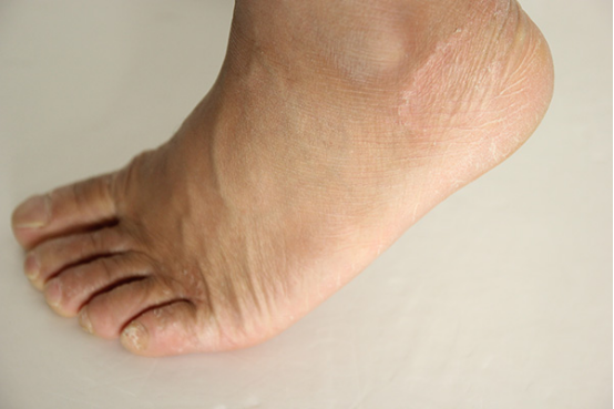 老人脚肿是怎么回事