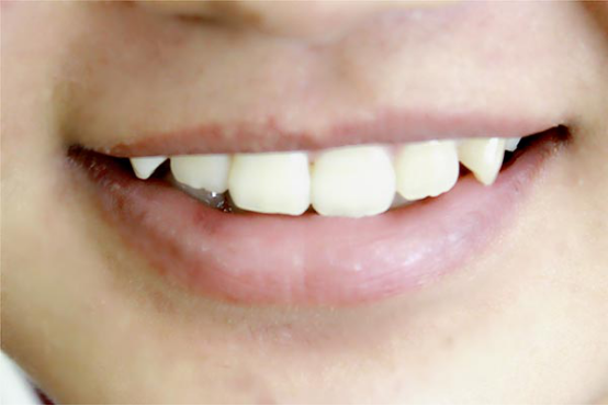 上牙的前端超出下牙牙冠的1/3左右,是正常情况,能够保证牙齿正常咬合