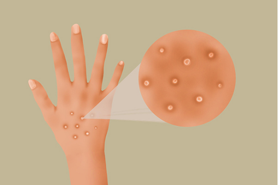 烫伤后水泡是否要弄破，要根据水泡的大小决定