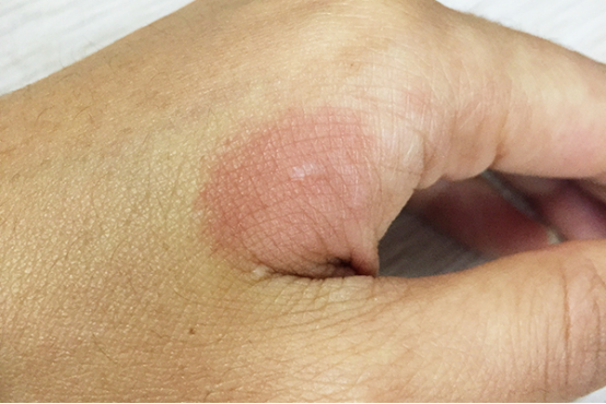 轻微烫伤的患者要立即用凉水冲洗