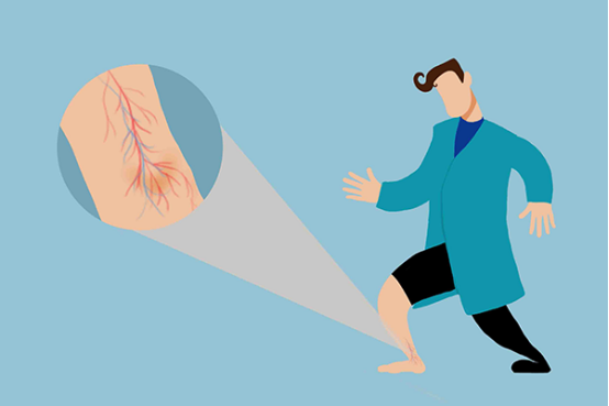 泡脚是很好的养生方式，对于治疗静脉曲张也有显著的效果