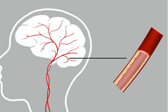 脑血栓也并不是高死亡率的疾病，只有10%左右的致死率