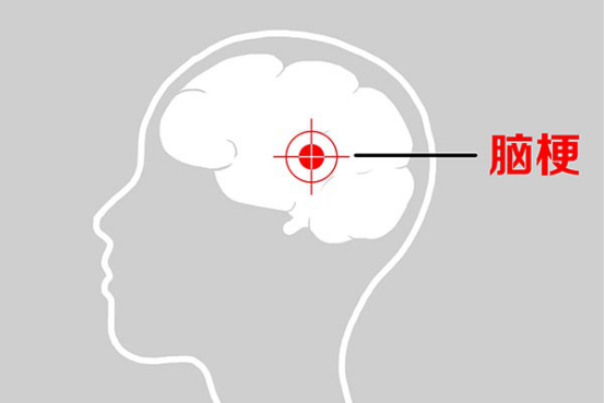 患有脑梗塞的人群，脑部容易经常出现缺血的情况