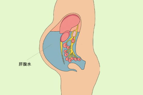 肝硬化腹水晚期能活多久,主要和患者的病情发展程度和治疗方法以及病人的情绪等因素有关系 肝硬化腹水晚期能活多久,主要和患者的病情发展程度和治疗方法以及病人的情绪等因素有关系