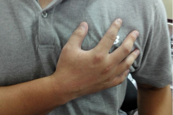 心肌炎的患者不能食用辛辣刺激的食物 心肌炎的患者不能食用辛辣刺激的食物