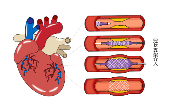 虽然说大多数的需要心脏放支架的人，都是心脏部位的血管出现了堵塞问题的人
