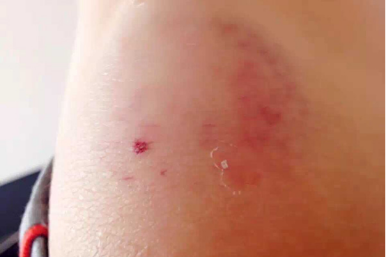 破伤风是一种由破伤风梭菌感染皮肤或者粘膜伤口引起的疾病