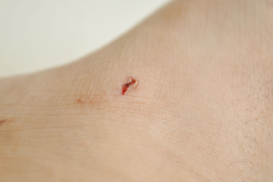 伤到什么程度打破伤风