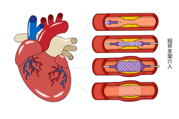 冠脉cta是一项明确冠心病的有效检查方式