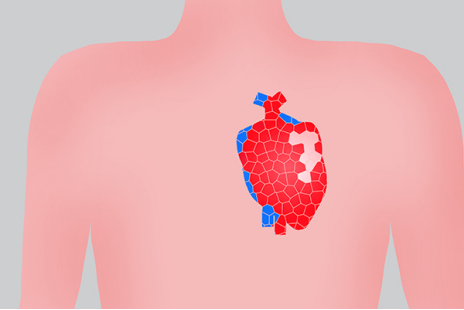 有些患者(通常是新生儿)，两个心室之间的室间隔会发育异常，导致室间隔的肌部或者膜部封闭不完整(孔洞)
