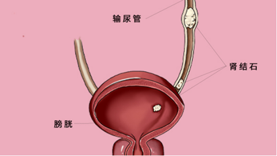 疼痛是膀胱结石患者最明显的表现,通常情况下都是在下腹部,由于每个人