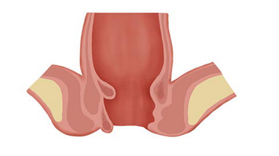 肛裂多发生于经常便秘的患者，长期的大便干结、排便不畅很容易给肛门带来一定的创伤