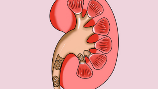 肾结石患者如果没有什么明显的症状不需要做特殊的治疗
