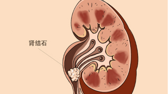 肾结石患者是可以吃柿饼的,柿饼不仅含人体所需的维生素和矿物质 肾结石患者是可以吃柿饼的,柿饼不仅含人体所需的维生素和矿物质