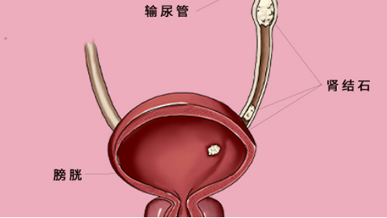 肾结石到了输尿管说明结石已经快要排出体外，患者可以到医院做个B超检查