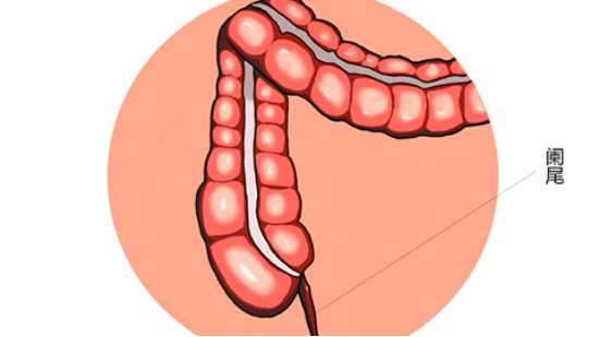人體的闌尾直通盲腸,若盲腸內有殘留的食物殘渣或者是盲腸因為受到