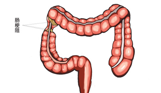 中国中医科学院广安门医院脾胃科任俊杰医生_肠梗阻的临床表现是什么