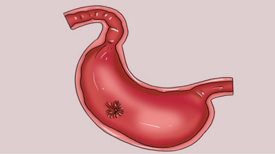 慢性胃炎患者常常还会伴随着消化不良，一直不停的打嗝