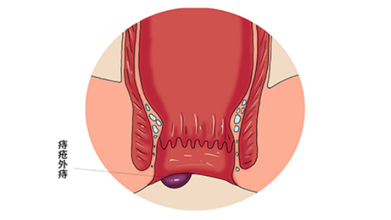 一般痔疮比较小的情况下，症状相对比较轻