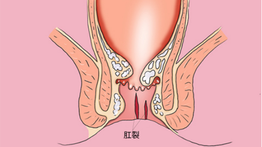 如果是肛窦炎导致的，也可以用中药坐浴来治疗
